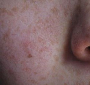 为什么治疗激素脸会有排毒反应？