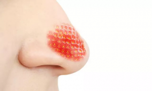 草莓鼻是玫瑰痤疮还是激素脸？
