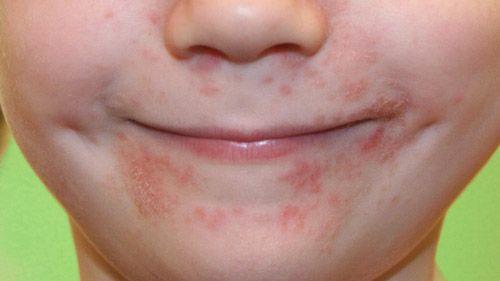 嘴巴周围冒痘红肿也是激素依赖性皮炎吗？