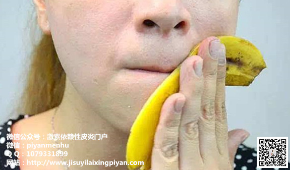 激素脸能用香蕉皮敷脸吗？对于治疗激素依赖性皮炎管用吗？