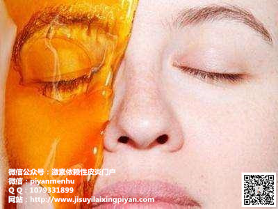 蜂蜜那么好，敷脸治疗对于激素脸有效果吗？目前治疗激素脸最有效的方法是什么？